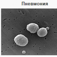 Pneumonia